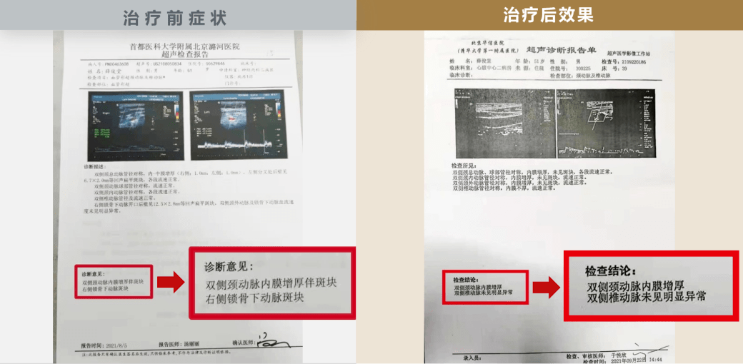 颈动脉斑块患者经过两个疗程共30天的三剂疗法治疗,影像检查报告显示
