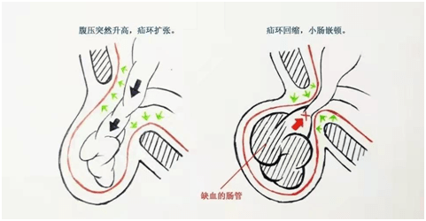 西安市第三医院开展腹腔镜下微创手术,为1岁半患儿摆脱腹股沟斜疝困扰