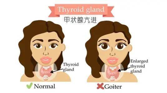 有可能是患上甲亢了_甲状腺_患者_炎症