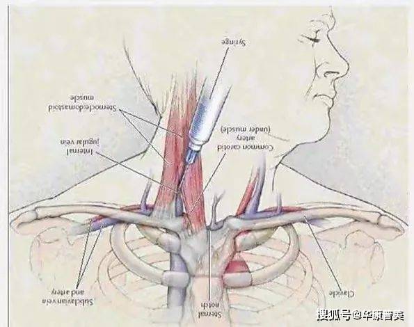 关于中心静脉置管技术你需要知道的那些事儿_锁骨_cm_患者