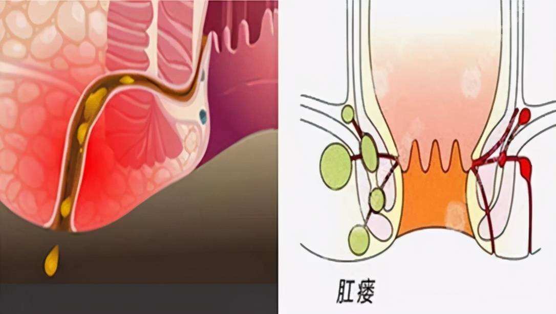 有人知道江苏徐州孙老师治疗肛瘘是真的吗?求告急_肛门_直肠_患者