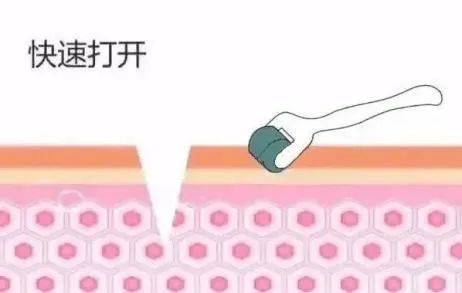 排出促进有效成分进入皮肤的同时微针在打开皮肤微小通道微针作用原理