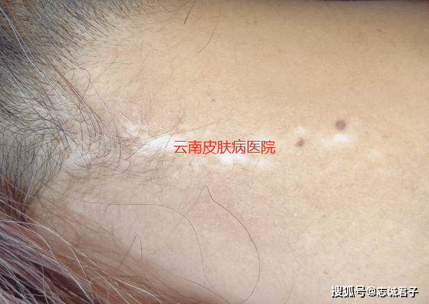 白斑和白癜风的区别,一文读懂_皮肤_部位_治疗