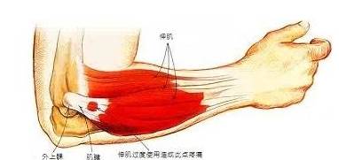 患上彀球肘怎么办呢？应该怎能处置……