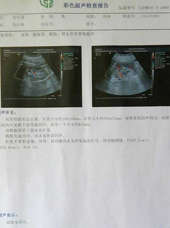 双肾多发小结石4x3mm怎么办？用此法一个月即可清除