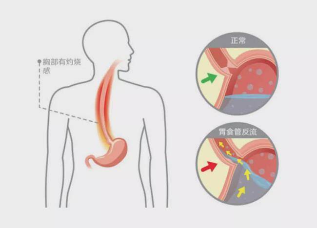 反酸、烧心，胃食管反流病是什么原因造成的？如何治疗？