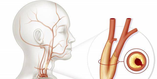 颈动脉一旦被堵，人体哪个部位反响最强烈？该怎么选择治疗？
