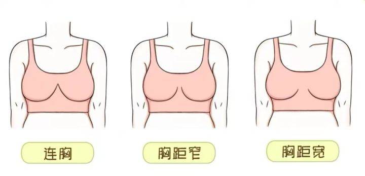女性胸外扩如何改善？