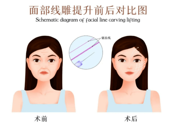 说实话：线雕面部提拔会不会越来越松？线雕几年后会更衰老吗？