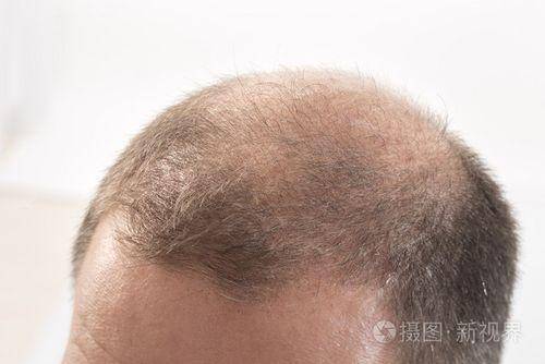 男人怎么会秃顶——破解脱发之谜对