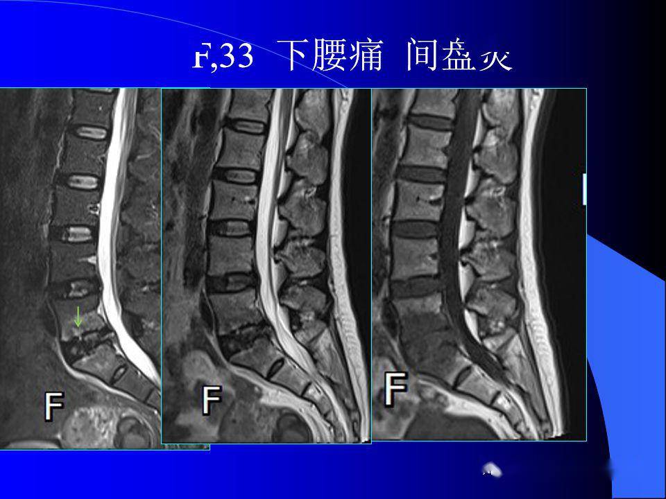 椎间盘发育,退变与病变mri表现