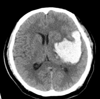 死地只有一招可以破解！脑组织被挤变形？这种快速置人于死地的危重状态