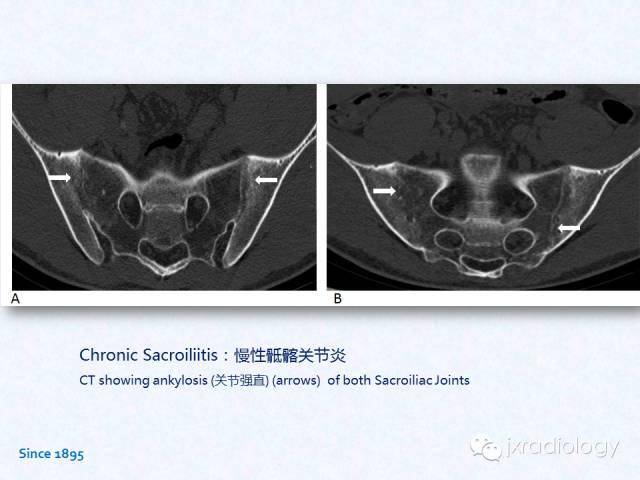 骶髂关节炎:x线,ct和mri表现