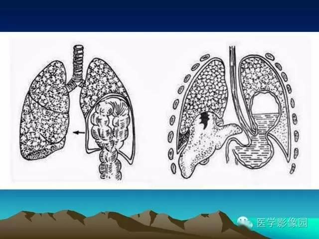 膈疝影像学表现