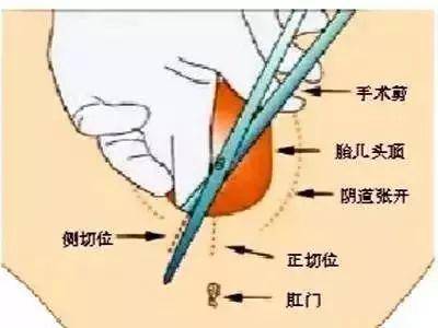 侧切伤口怎样护理更科学