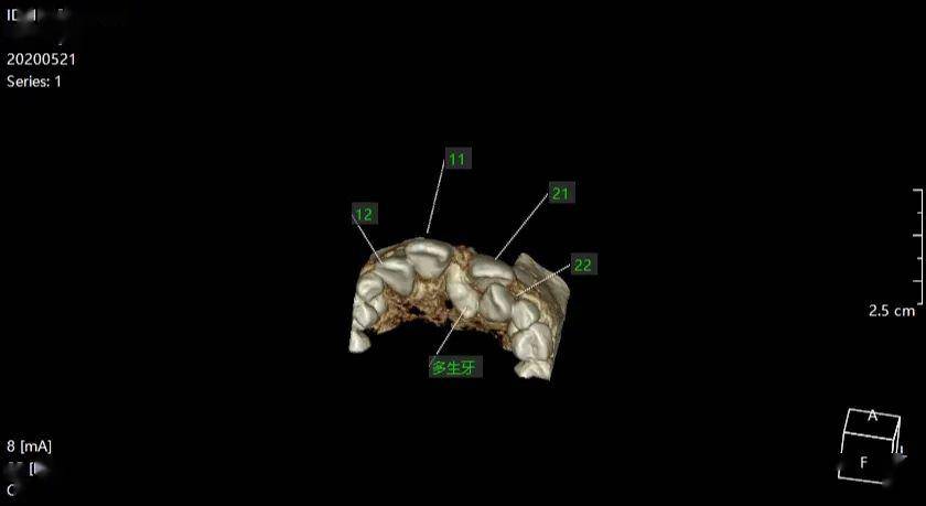罗XX 20200521 多生牙CBCT 137XXXX3333