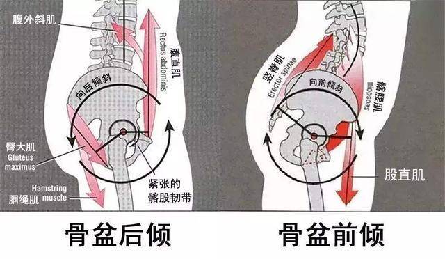 骨盆前倾,髂腰肌紧张而臀大肌和腘绳肌力量薄弱,骨盆变形,股骨大转子