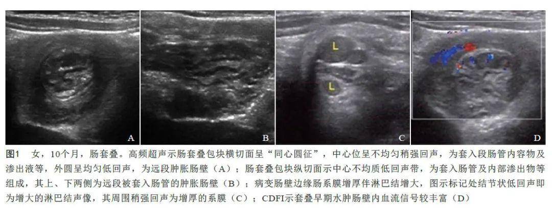 (7)影像学检查看到导致梗阻的粪块或肠套叠的包块