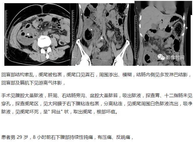 急性阑尾炎 ct 表现