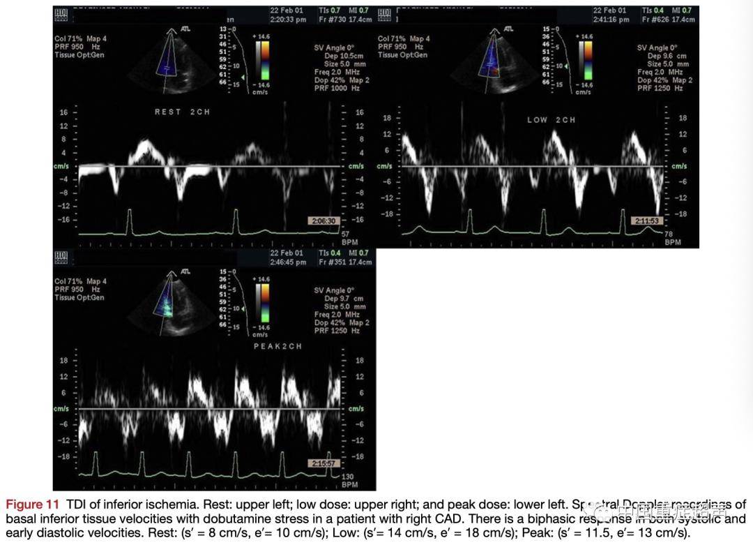 大知闲闲wed美国超声心动图学会缺血性心脏病的负荷超声心动图表现