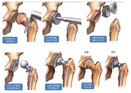 因右侧股骨头坏死于两年前在我院行右侧全髋关节置换术后,术后患者