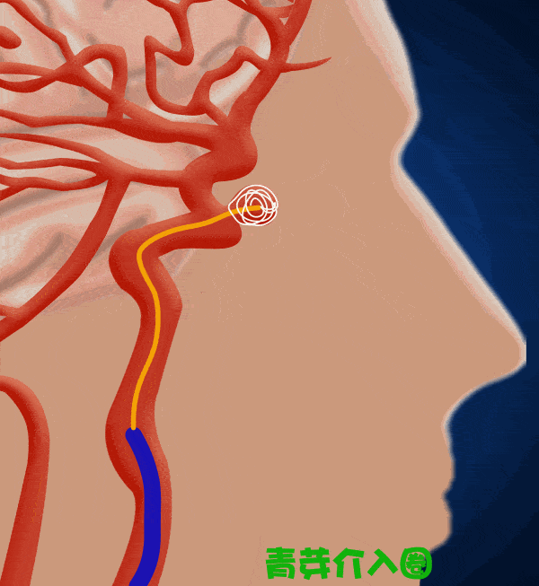动图演示颅内动脉瘤介入栓塞治疗全过程