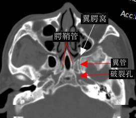 一文搞懂复杂解剖:翼腭窝