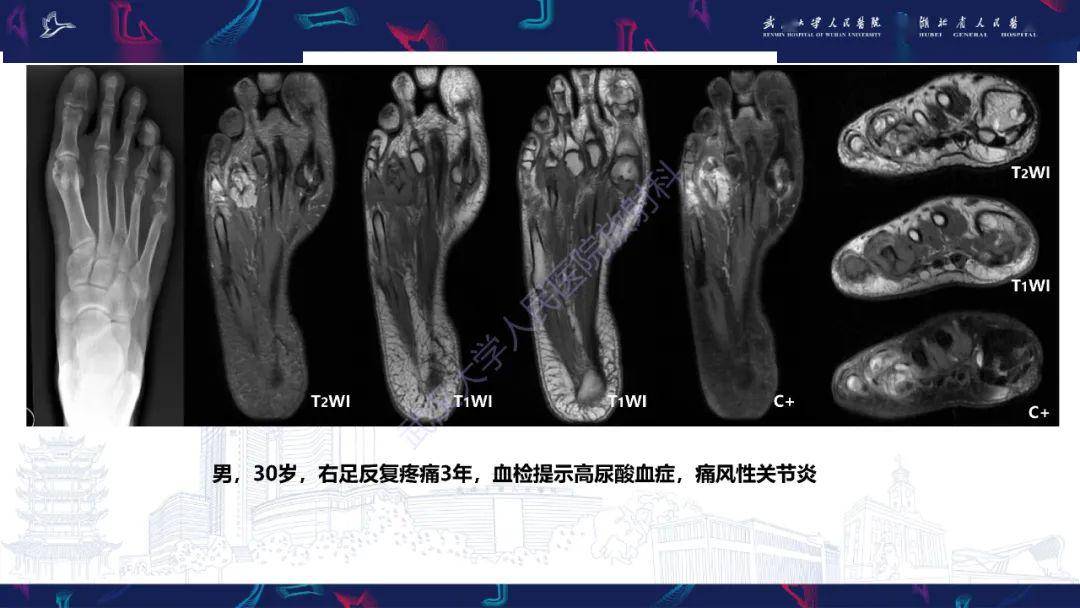 关节痛风影像诊断