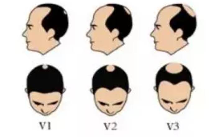 目前常用的脱发分型方法是发际线形态,额部与顶部头发密度进行分级的