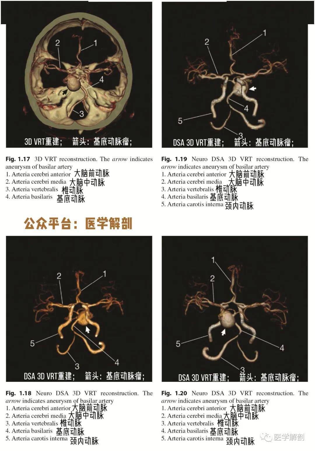 脑cta图谱 基底动脉瘤_解剖