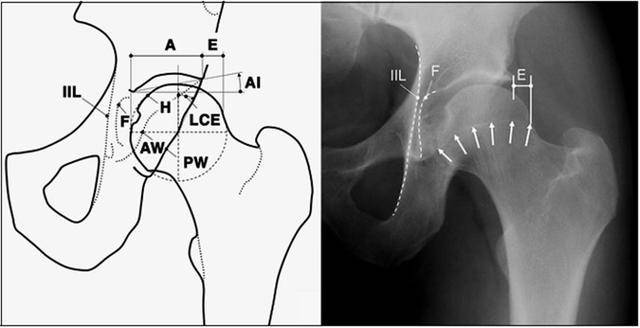 iil:髂坐线;aw:髋臼前壁缘;pw:髋臼后壁缘;a为股骨头被髋臼覆盖部分的
