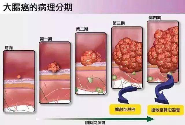 一地公布最新癌症榜,近2.8万人"上榜"!这些人群高危,赶紧看下有没有你