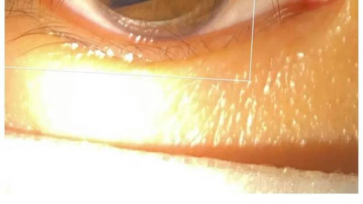 瞳孔突然变成三角形,是不是新冠后遗症?