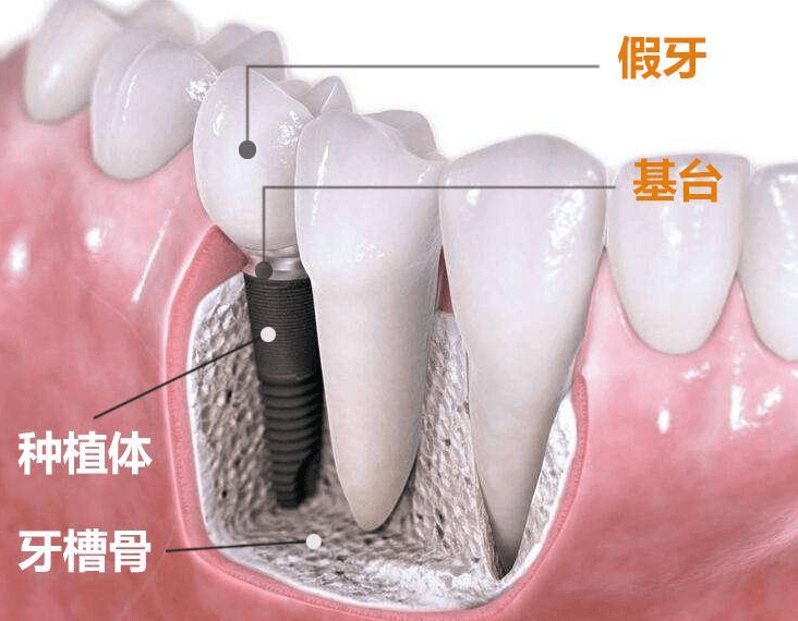种植牙真的那么可怕吗?听杭州种植牙专家黄博士为您解答