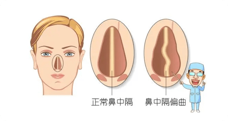 清华大学中西医结合医院鼻科专家申力:什么是鼻中隔偏曲