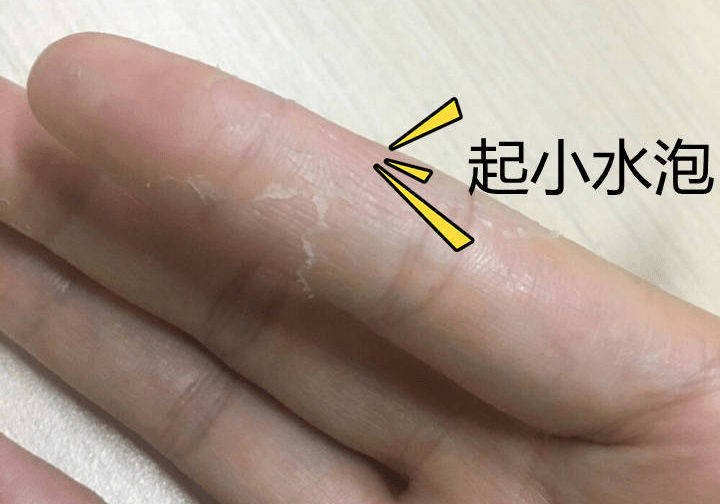 女,23岁(深圳)手上起一些小水泡,痒痒,之前一小片,现在各个手指陆续