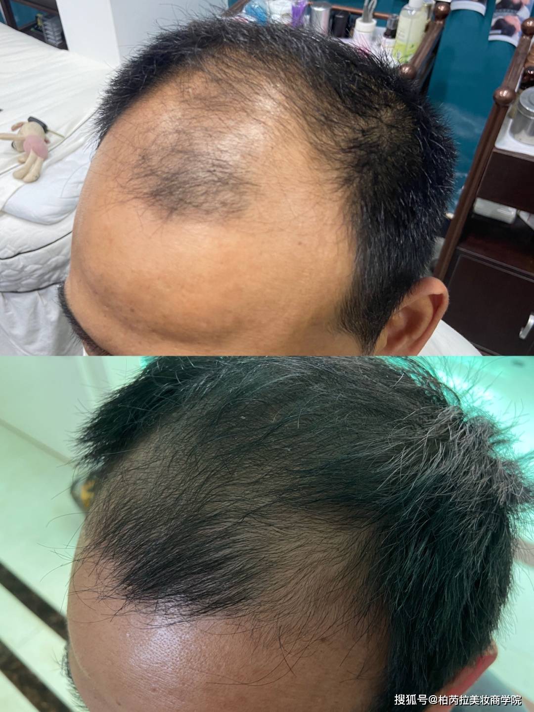 男生脱发原因各不同,唯一相同的是都会变老变丑!