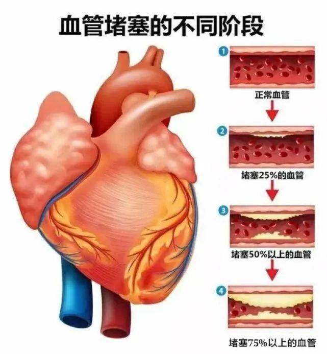 出现这4个症状,你的血管可能堵塞了!赶快自查