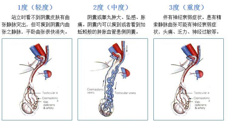 孕育科普:精索静脉曲张可以分为三个等级_阴囊