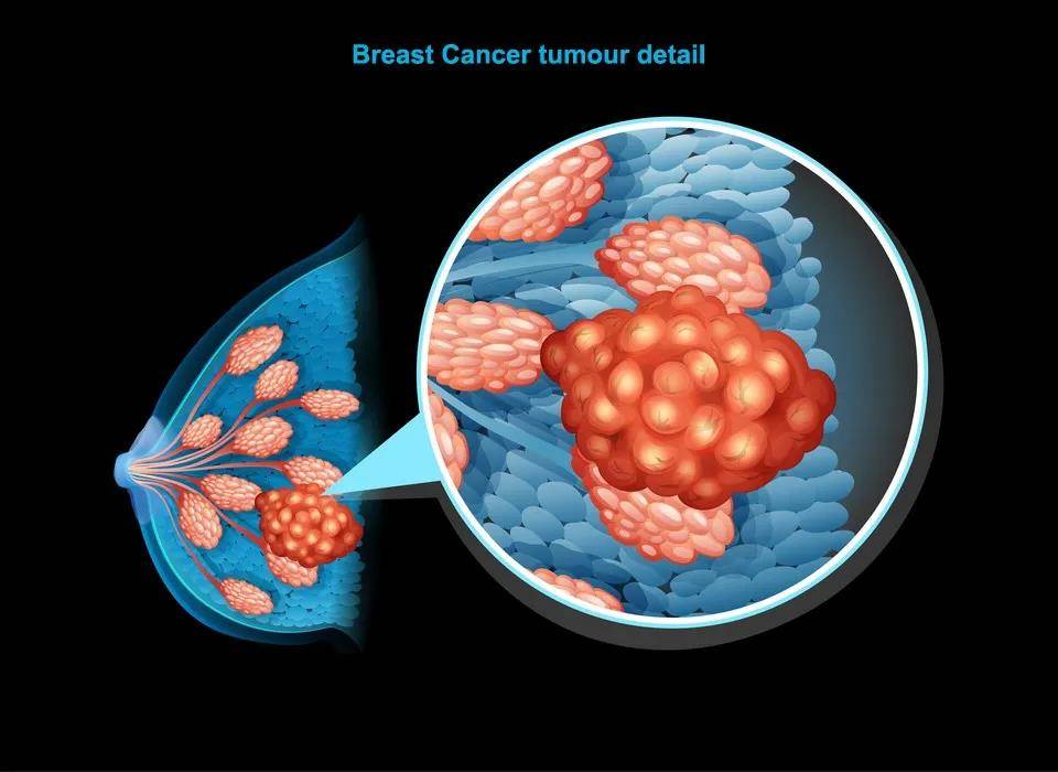 三阴性乳腺癌治疗新方案!k药联合化疗,降低疾病进展风险37%