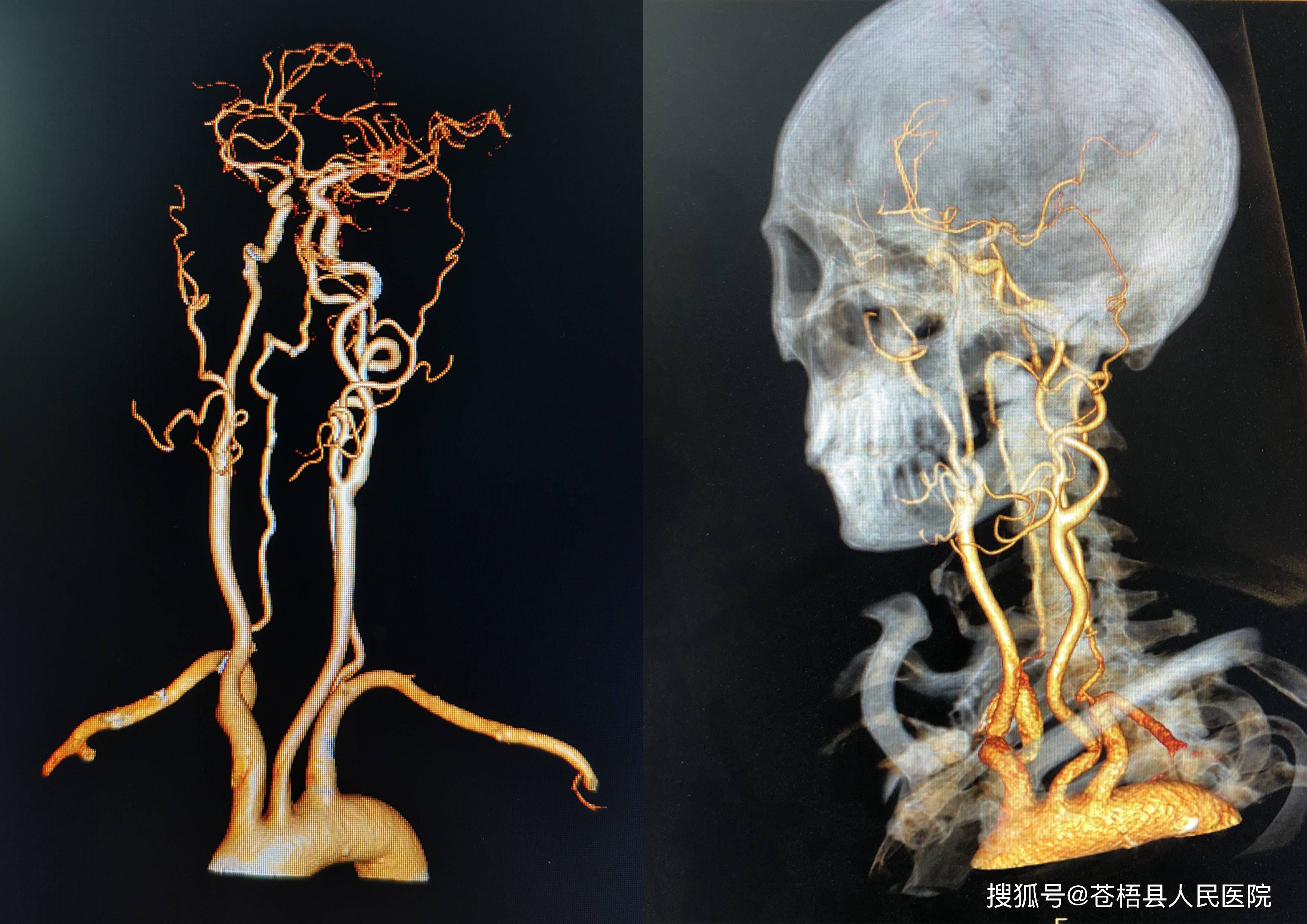 尤其是显示冠状动脉,头颈部动脉及四肢血管,可以大部分取代传统插管