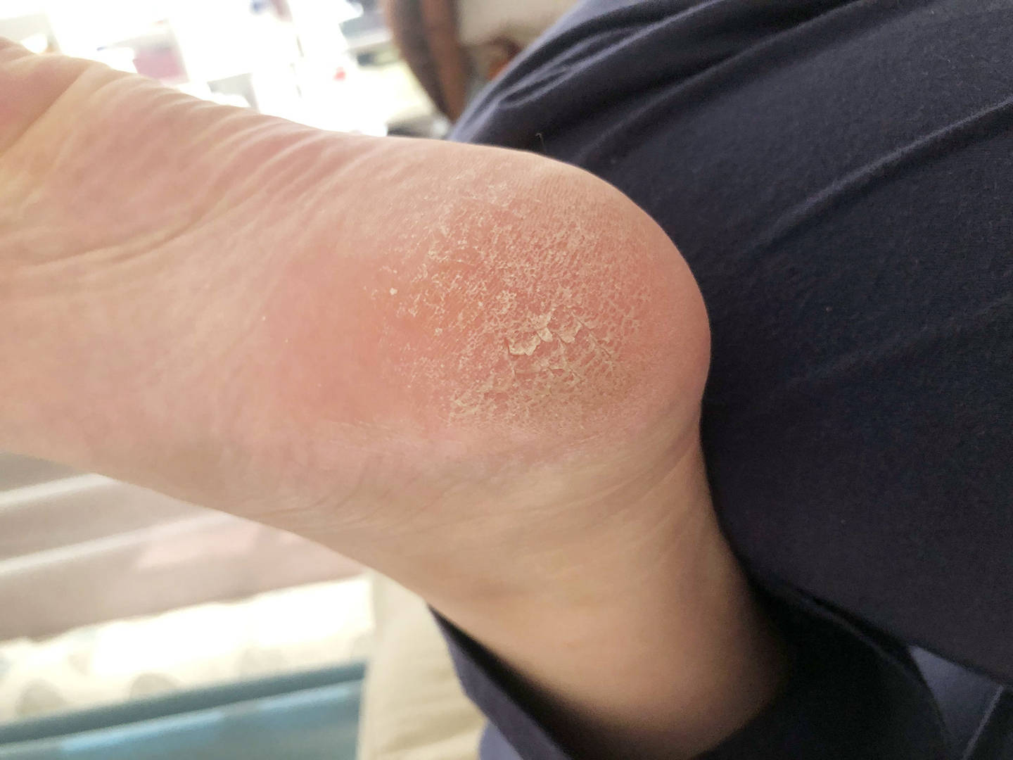 危害:脚上皮肤最大的特点就是角质层较厚,如果已经到了二度皲裂,三度