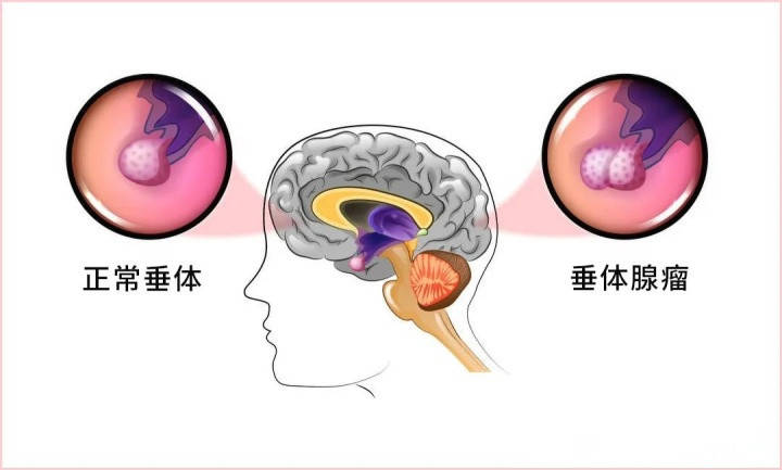 【就诊指南】脑垂体瘤如何选择治疗方案?