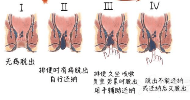 痔疮手术要多少钱?_伤口