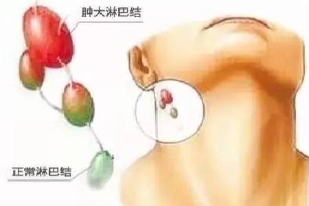 首大赵桂丽:颈部淋巴结肿大的病因