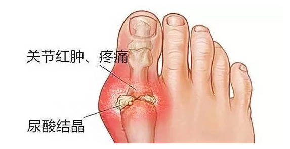 多,排泄少而导致高尿酸血症,高尿酸达到一定的浓度,就可以沉积到关节