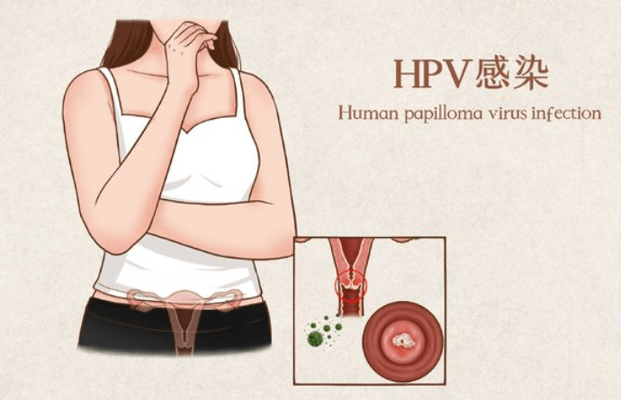 腿部异常别忽视从小红点到菜花或是hpv在搞鬼劝你早重视