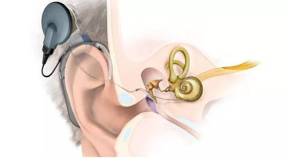 就是人工植入可以代替耳蜗功能的设备.