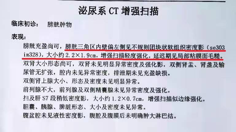 尿血3个月竟是膀胱癌身体出现这5种异常应及时检查