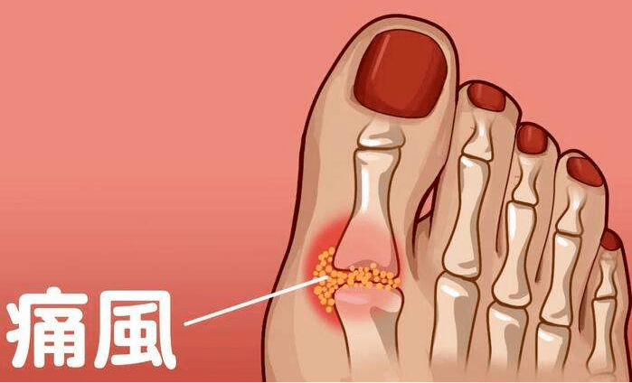 警惕高尿酸!帮你一起对抗痛风.